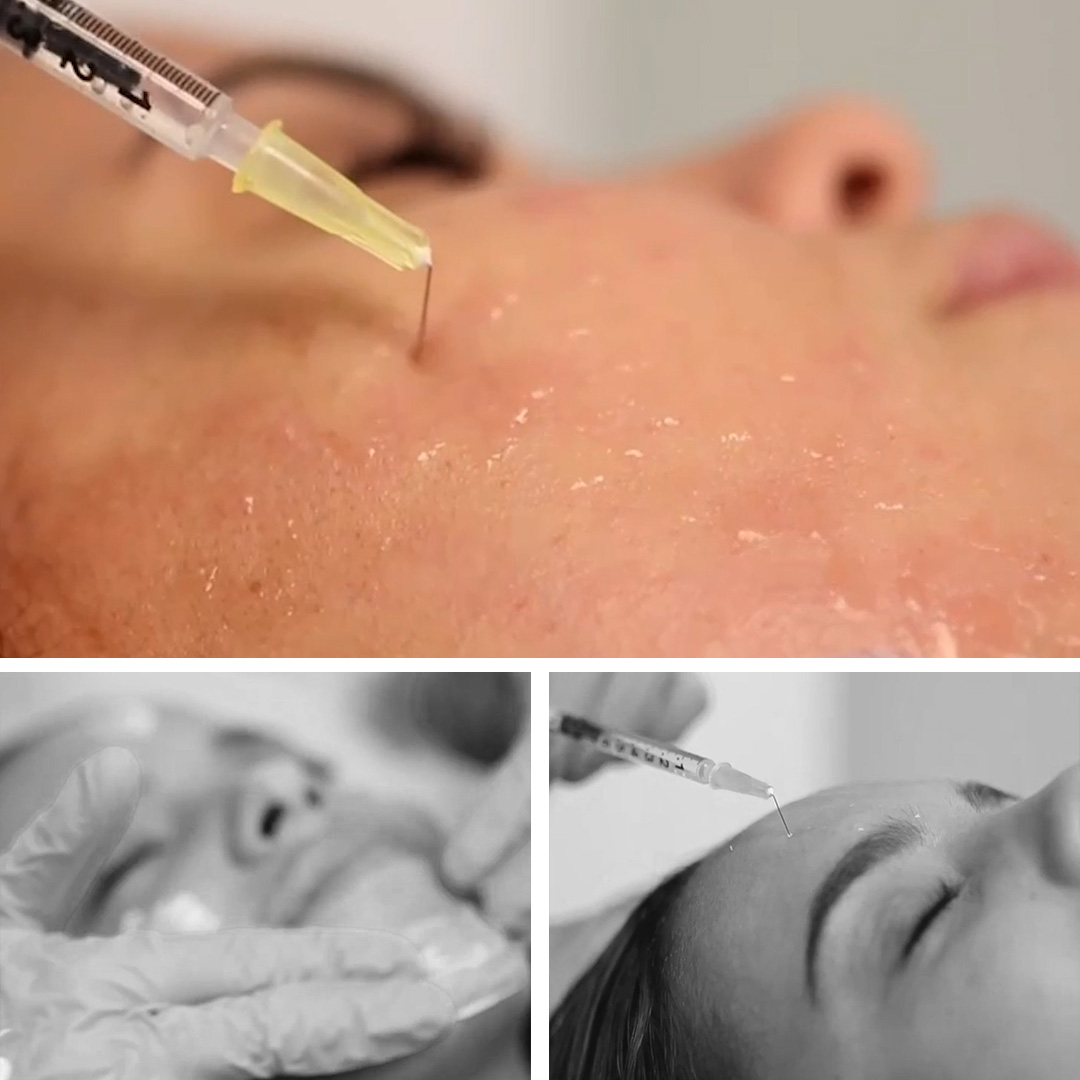 mesoterapia-vitaminas-clinicas-diego-de-leon