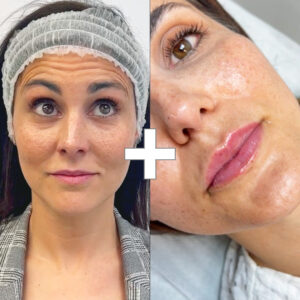 BYE BYE Arrugas + Diseño de Labios