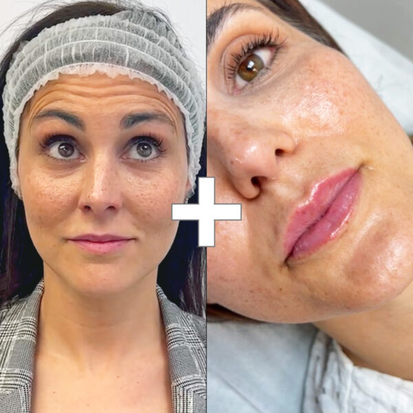 BYE BYE Arrugas + Diseño de Labios