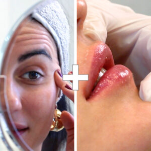 BYE BYE Arrugas + Diseño de Labios